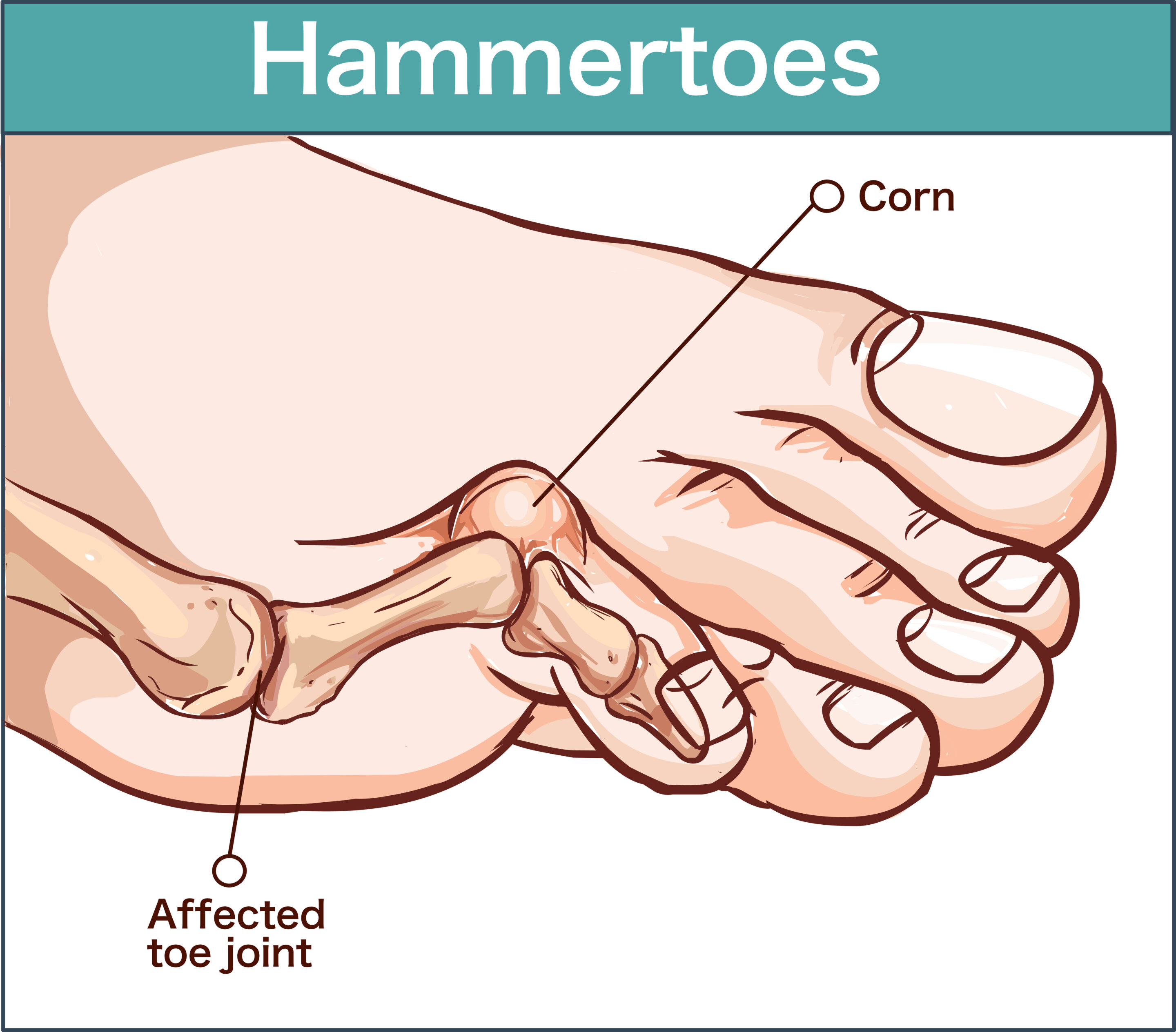 vector illustration of hammertoes.