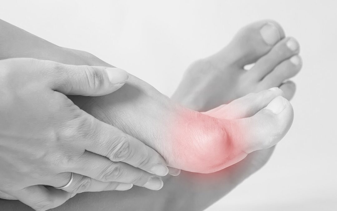 Your Guide on What to Expect After Bunion Treatment