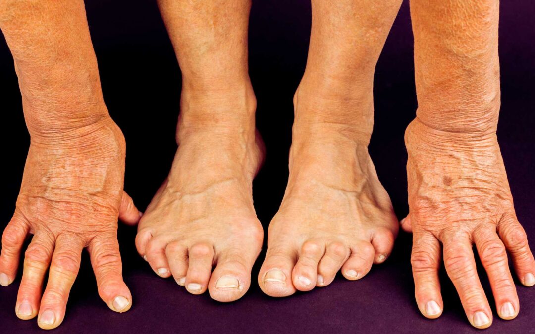 A Complete Guide to Hammertoes