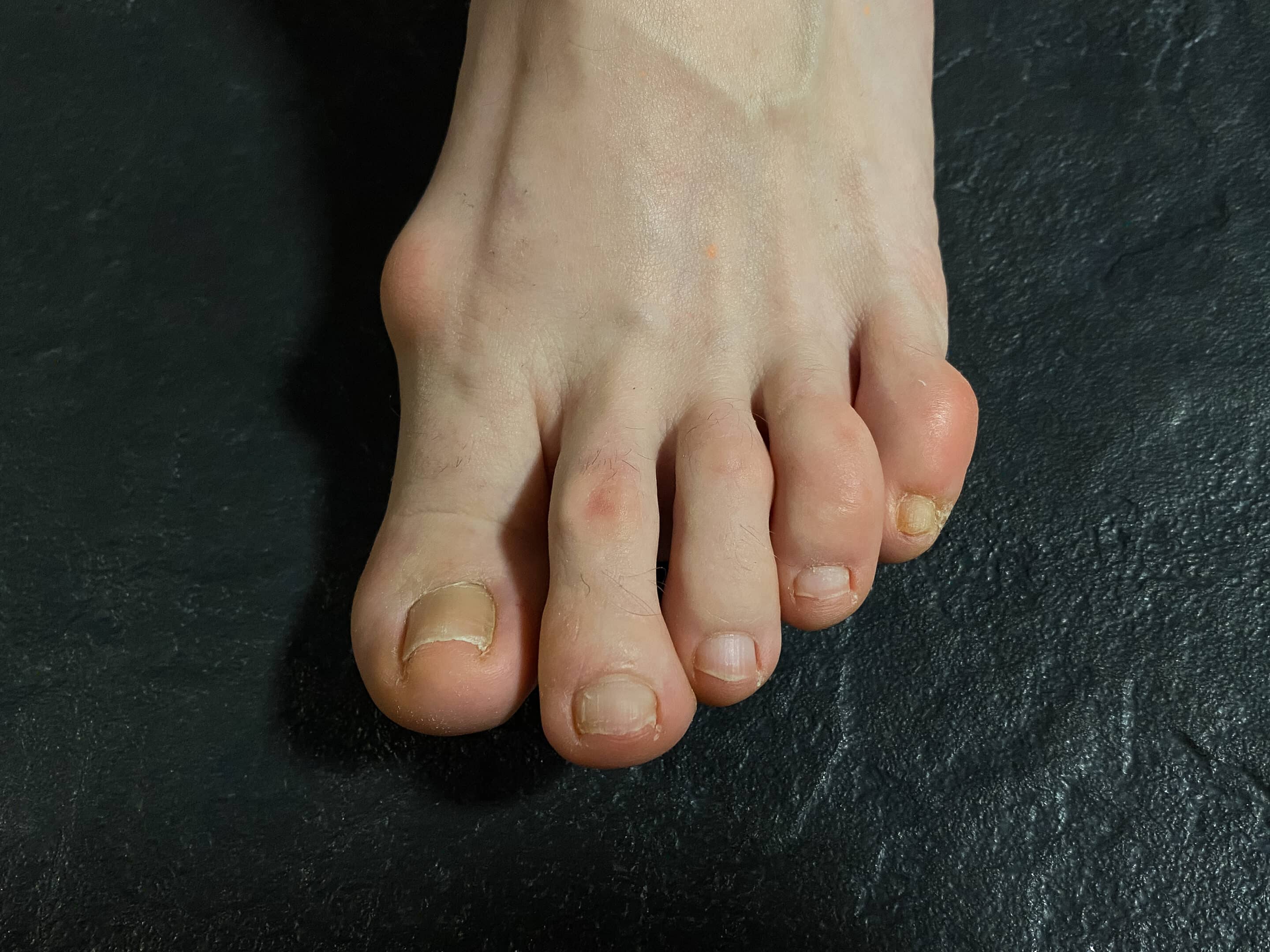 Bony protrusion on female foot, close-up. Swollen Bunion or Painful bunion. Hallux abducto valgus (HAV). Disease leg bones and joints. Toenail fungus Beige orthopedic insoles on light grey marble background, flat lay.