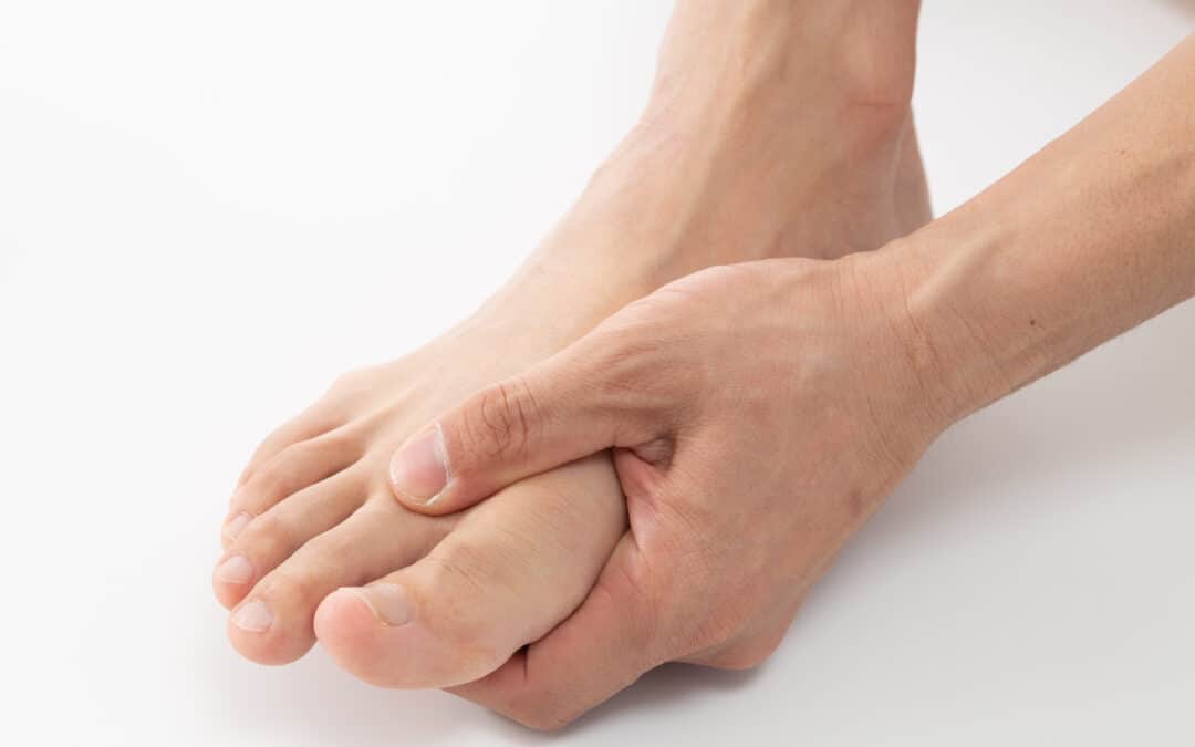 How Do I Get Rid of a Bunion?