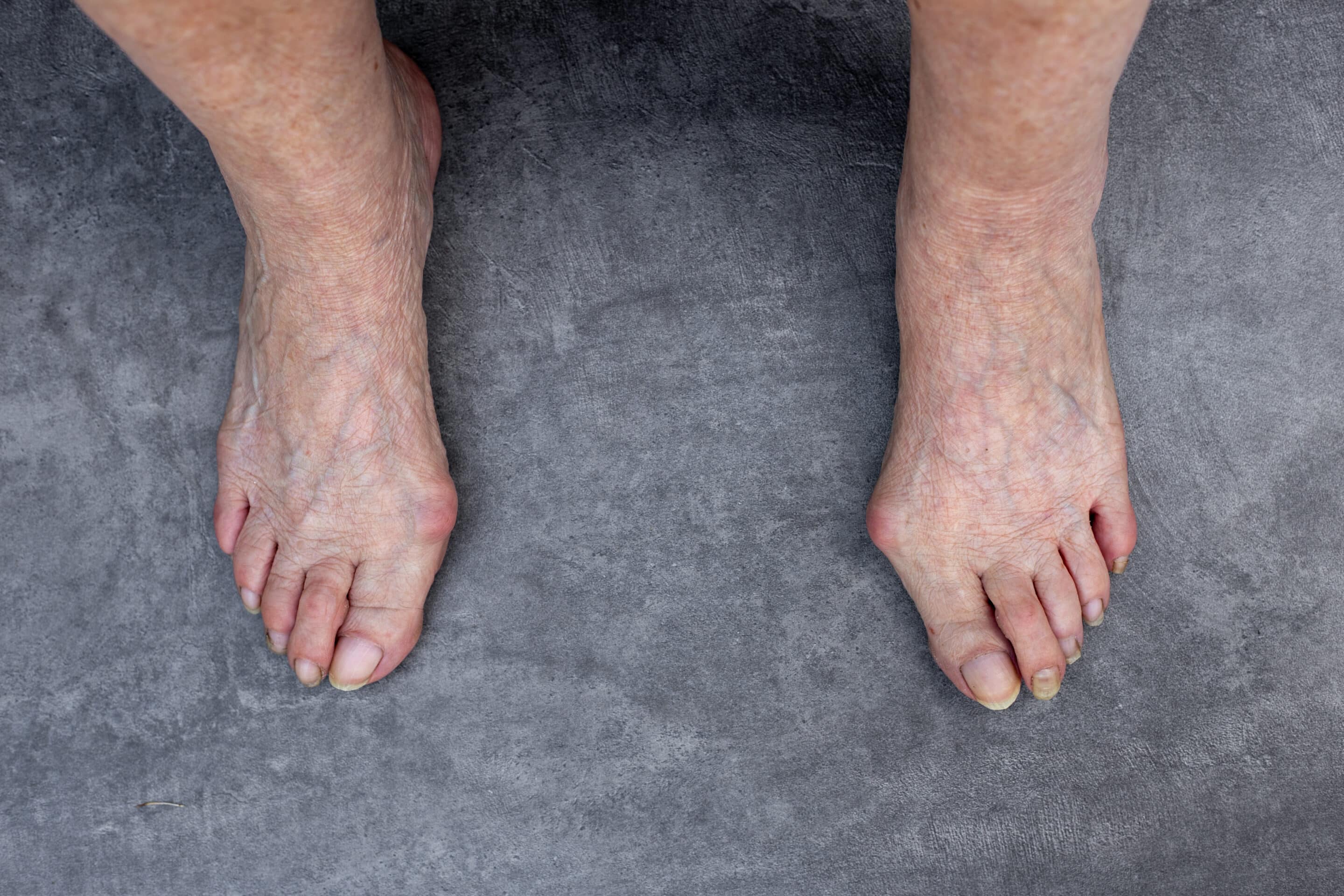 An old woman's feet with untrimmed nails and a painful, enlarged bunion.