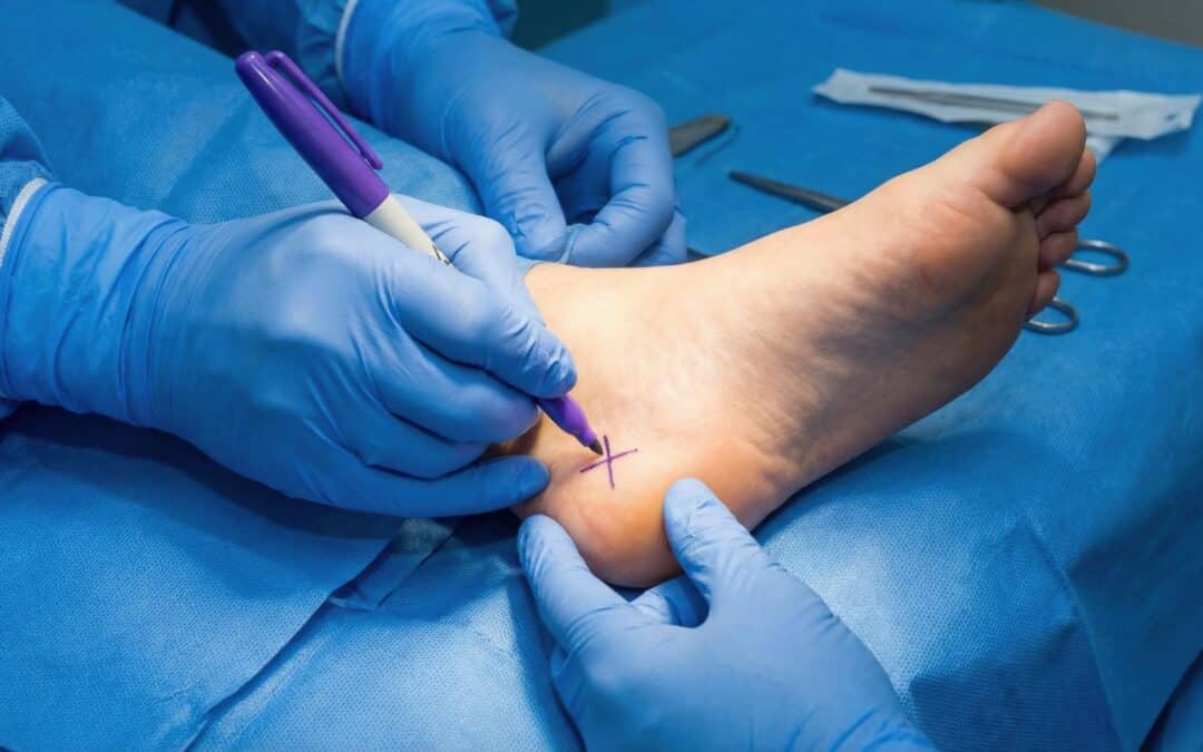 Foot & Ankle Surgery Recovery Tips: 5 Ways to Heal Faster in Pittsburgh, PA